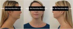 Harold Eburdery - femme de 31 ans
lipoaspiration du cou, du rebord mandibulaire et des bajoues