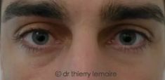 Dr Thierry Lemaire - Photos avant et 7 mois après un lipofilling des cernes dus à des poches sous les yeux assez importantes.