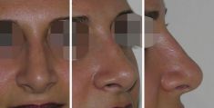 Rhinoplastie - Cliché avant - Dott. Andrea La Padula M.D.