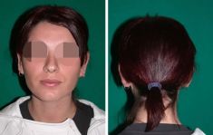 Otoplastie (Chirurgie esthétique des oreilles) - Cliché avant - Dott. Andrea La Padula M.D.