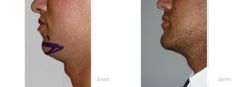 Génioplastie - Chirurgie esthétique du menton - Cliché avant - Dr Franck Ouakil