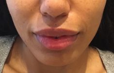 Augmentation des lèvres - Cliché avant - Dr Raphaële Rossarie