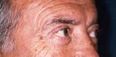 Blépharoplastie - Cliché avant - Dott. Andrea La Padula M.D.