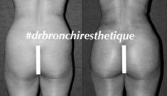 Augmentation et modelage des fesses et des hanches - Cliché avant - DOCTEUR THIERRY BRON