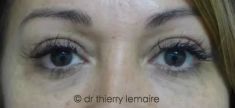 Dr Thierry Lemaire - Résultat d’un lipofilling chez une patiente présentant des cernes dus à des poches sous les yeux peu importantes.