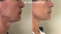 Lifting du visage - Cliché avant - Dr Eric BONAFOS