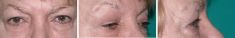 Blépharoplastie - Cliché avant - Dott. Andrea La Padula M.D.