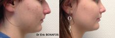 Rhinoplastie - Cliché avant - Dr Eric BONAFOS