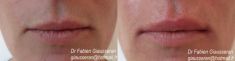 Augmentation des lèvres - Cliché avant - Dr Fabien Giausseran