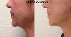 Lifting du visage - Cliché avant - Dr Eric BONAFOS