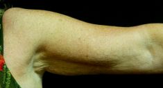 Lifting des bras - Cliché avant - RS Esthétique - Centre d’amincissement & remodelage de la silhouette anti-âge visage et corps sans chirurgie