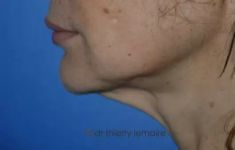 Lifting du cou - Il existait un excédent de peau important au niveau du cou. Le lifting du visage a permis d’obtenir un angle du cou bien défini de façon durable.