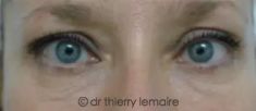 Dr Thierry Lemaire - Résultat 4 ans après deux séances de lipofilling des cernes dus à des poches sous les yeux.. Les cernes ont disparu sans faire de chirurgie des paupières (blépharoplastie)