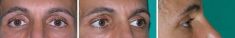 Blépharoplastie - Cliché avant - Dott. Andrea La Padula M.D.