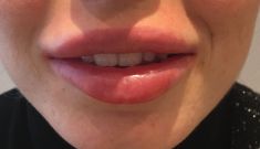 Augmentation des lèvres (acide hyaluronique) - Ourlet et hydratation des lèvres supérieures et inférieures avant et immédiatement après injection d