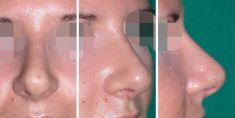 Rhinoplastie - Cliché avant - Dott. Andrea La Padula M.D.