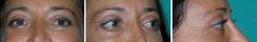 Blépharoplastie - Cliché avant - Dott. Andrea La Padula M.D.