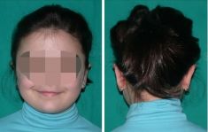 Otoplastie (Chirurgie esthétique des oreilles) - Cliché avant