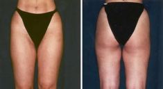 Liposuccion - Cliché avant - Dott. Andrea La Padula M.D.
