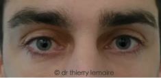 Dr Thierry Lemaire - Photos avant et 7 mois après un lipofilling des cernes dus à des poches sous les yeux assez importantes.