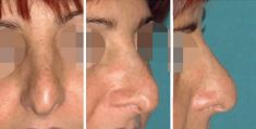 Rhinoplastie - Cliché avant - Dott. Andrea La Padula M.D.