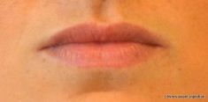 Augmentation des lèvres - Cliché avant - Dr James Schinazi