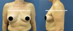 Reconstruction mammaire - Cliché avant