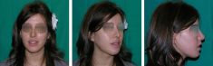 Génioplastie - Chirurgie esthétique du menton - Cliché avant - Dott. Andrea La Padula M.D.