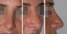 Rhinoplastie - Cliché avant - Dott. Andrea La Padula M.D.