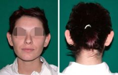 Otoplastie (Chirurgie esthétique des oreilles) - Cliché avant - Dott. Andrea La Padula M.D.
