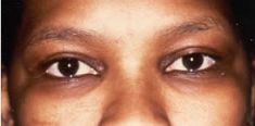 Blépharoplastie - Cliché avant - Dott. Andrea La Padula M.D.