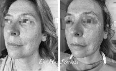 Lifting Facial Silhouette Soft - Cliché avant - Dr Hai Seroussi