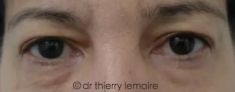 Blépharoplastie inférieure - La suppression de l’excédent de peau au niveau des paupières supérieures et des poches au niveau des paupières inférieures a permis d’obtenir un effet « bonne mine » sans modification du regard.