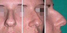 Rhinoplastie - Cliché avant - Dott. Andrea La Padula M.D.