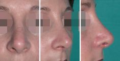 Rhinoplastie - Cliché avant - Dott. Andrea La Padula M.D.