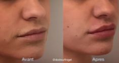 Augmentation des lèvres (acide hyaluronique) - Cliché avant - Dr Nicolas Froget