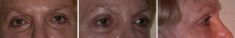 Blépharoplastie - Cliché avant - Dott. Andrea La Padula M.D.
