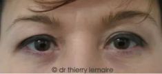Dr Thierry Lemaire - Photos avant et après un lipofilling des cernes dus à des poches sous les yeux minimes mais suffisantes pour donner un air fatigué.