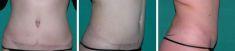 Abdominoplastie - Cliché avant