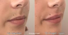 Augmentation des lèvres (acide hyaluronique) - Cliché avant - Dr Nicolas Froget
