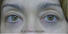 Lipofilling du visage - Cliché avant - Dr Thierry Lemaire
