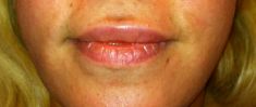 Augmentation des lèvres - Cliché avant - Dr Nicolas Zwillinger