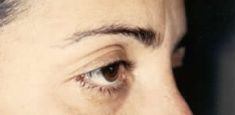 Blépharoplastie - Cliché avant - Dott. Andrea La Padula M.D.
