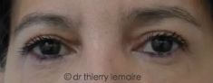 Blépharoplastie inférieure - La suppression de l’excédent de peau au niveau des paupières supérieures et des poches au niveau des paupières inférieures a permis d’obtenir un effet « bonne mine » sans modification du regard.