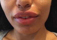Augmentation des lèvres - Cliché avant - Dr Raphaële Rossarie