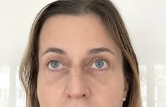 Dr Marie-Charlotte Dutot - Blépharoplastie 4 paupières avec lipofilling du cerne