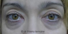 Lipofilling du visage - Cliché avant - Dr Thierry Lemaire