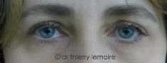 Dr Thierry Lemaire - Photos avant et 4 mois après une chirurgie des paupières supérieures. L’excédent de peau donnait un aspect presque ténébreux au regard. La blépharoplastie supérieure a permis de rajeunir le regard et de mettre en valeur la couleur des yeux.
