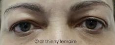 Dr Thierry Lemaire - Photos avant et 3 mois après une blépharoplastie supérieure. Chez cette femme la peau était très épaisse et contribuait à donner un regard fatigué et lourd. En enlevant la peau en excédent il a été possible de rajeunir et d’alléger l’expression du regard.