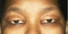 Blépharoplastie - Cliché avant - Dott. Andrea La Padula M.D.